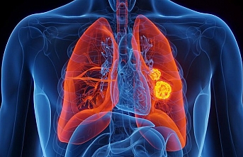 Önlem alınmazsa kanser kaynaklı ölümler 2050’ye kadar iki katına çıkacak