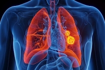 Önlem alınmazsa kanser kaynaklı ölümler 2050’ye kadar iki katına çıkacak